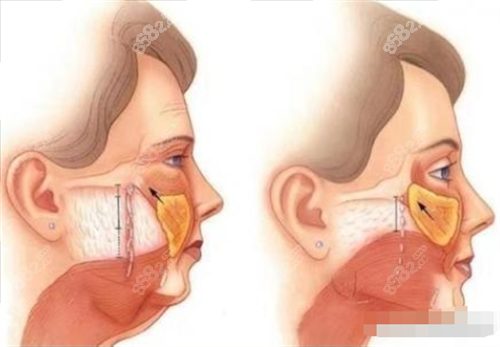 拉皮前后皮膚內(nèi)部以及表面變化圖