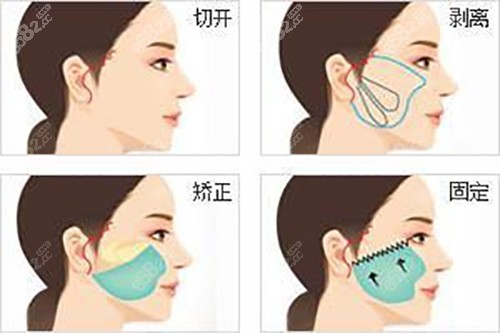 面部耳際小切口拉皮示意圖