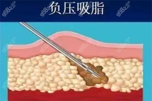 負(fù)壓吸脂