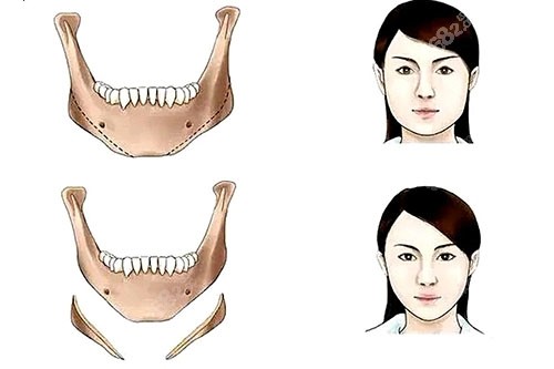 下頜角整形卡通對比圖 下頜角整形卡通對比圖