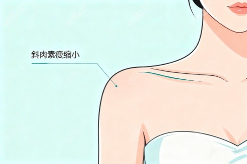 直角肩注射卡通圖