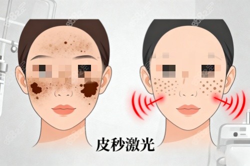 臉部做皮秒激光祛斑卡通圖 臉部做皮秒激光祛斑卡通圖