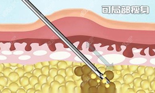 吸脂內(nèi)部卡通圖