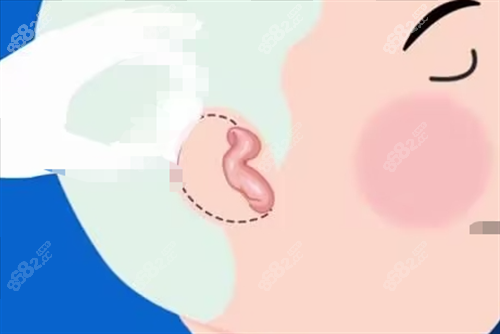 兒童耳再造耳畸形展示