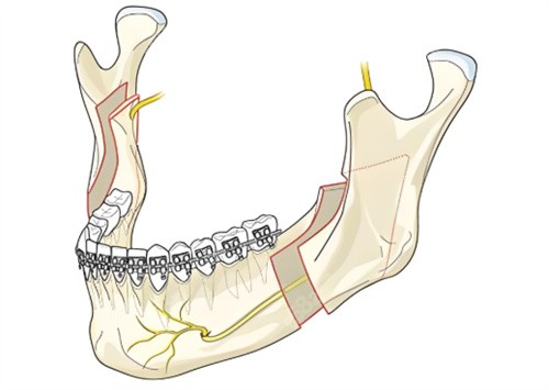 下頜角手術動畫 下頜角手術動畫