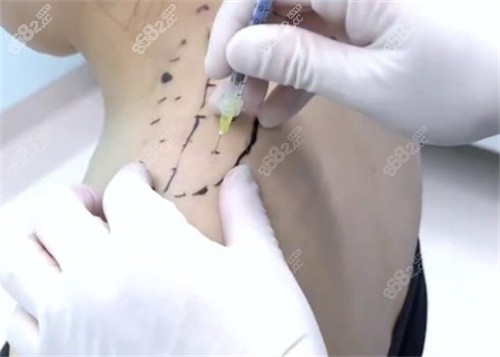 直角肩注射設(shè)計(jì)點(diǎn)位圖