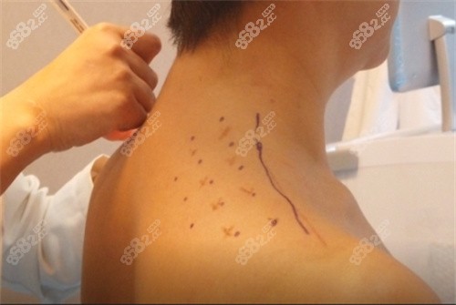 直角肩注射位置術(shù)前設(shè)計(jì)