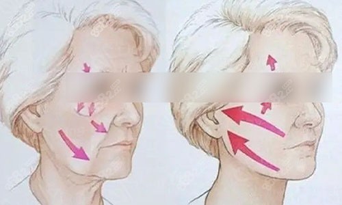 做拉皮手術(shù)前后動畫圖