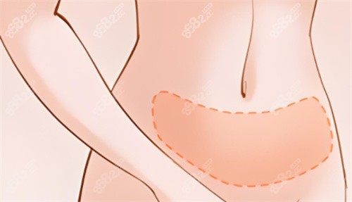 吸脂腹部區(qū)域 吸脂腹部區(qū)域