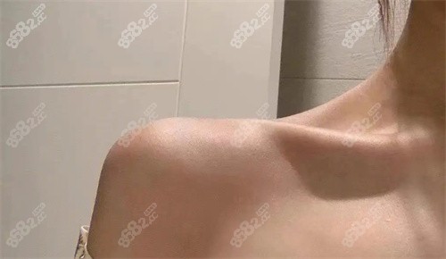 直角肩注射后照片