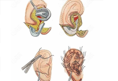 耳再造手術(shù)步驟展示