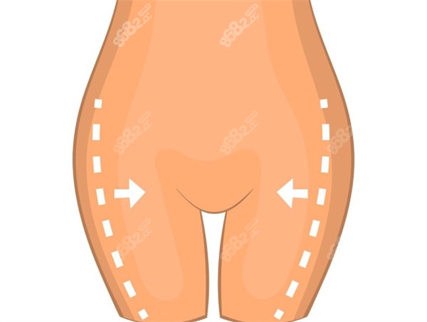 大腿吸脂手術(shù)卡通圖