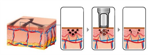 激光祛斑作用原理 激光祛斑作用原理
