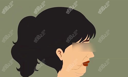 拉皮手術(shù)前的動畫示意圖