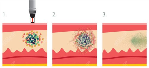 蜂巢皮秒祛斑 蜂巢皮秒祛斑