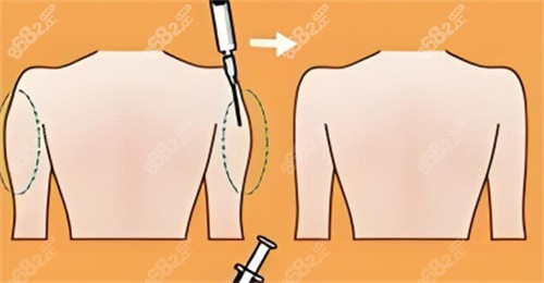 手臂吸脂前后對比