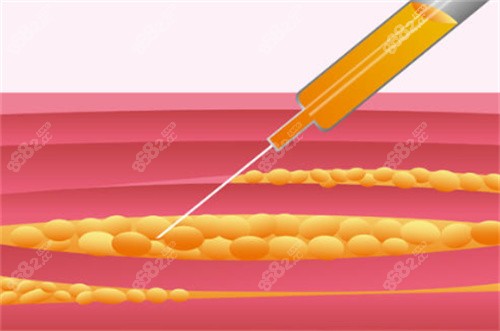 吸脂手術(shù)過程原理卡通圖