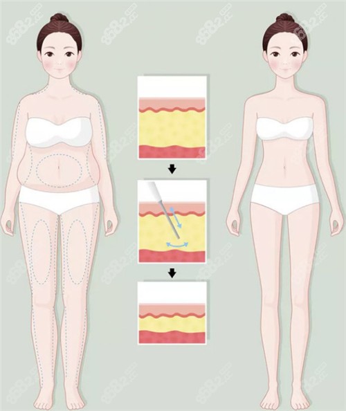 吸脂前后動(dòng)畫圖示