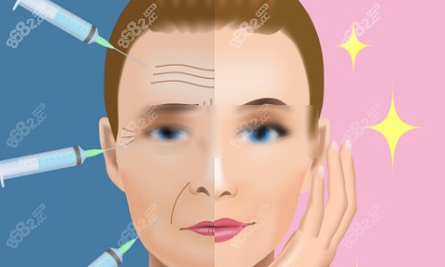 脂肪填充前后對比圖