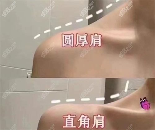 圓肩膀和直角肩對(duì)比