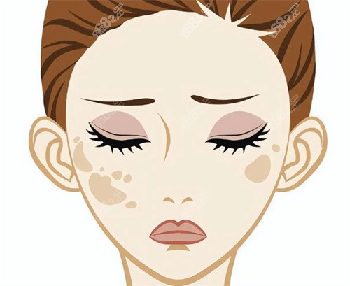 祛斑治療卡通圖片 祛斑治療卡通圖片