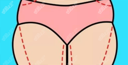 大腿吸脂術(shù)前畫線展示圖