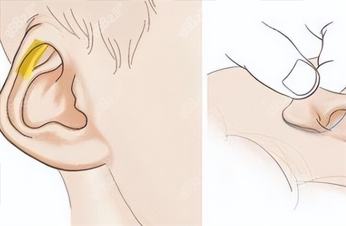 耳再造耳部畸形動畫展示