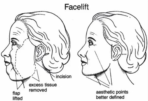 面部提升改善皮膚下垂等問題