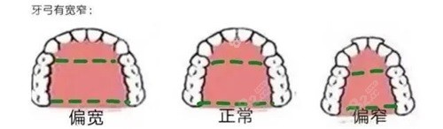 牙齿矫正牙弓形状