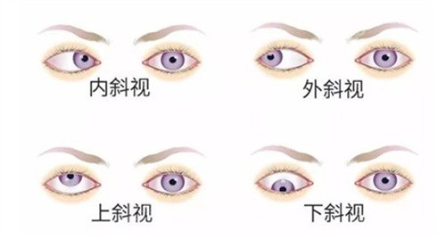 北京民众做斜视怎么样？侯宝杰/苏金萍小创口矫正技术成熟反馈好，附地址