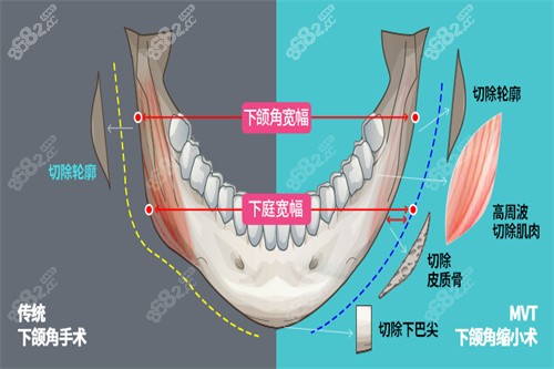 下颌角手术宣传图 下颌角手术宣传图