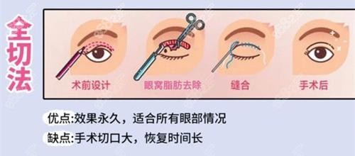 双眼皮手术全切法动画演示图 双眼皮手术全切法动画演示图