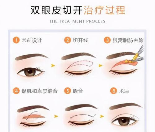 双眼皮手术方法过程图 双眼皮手术方法过程图