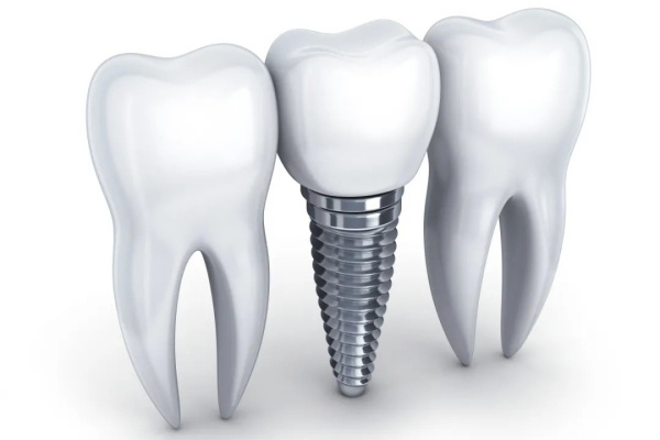 清遠(yuǎn)粵美口腔醫(yī)院種牙費(fèi)價(jià)格表出爐！多品牌多方式種牙費(fèi)用2800元起/顆