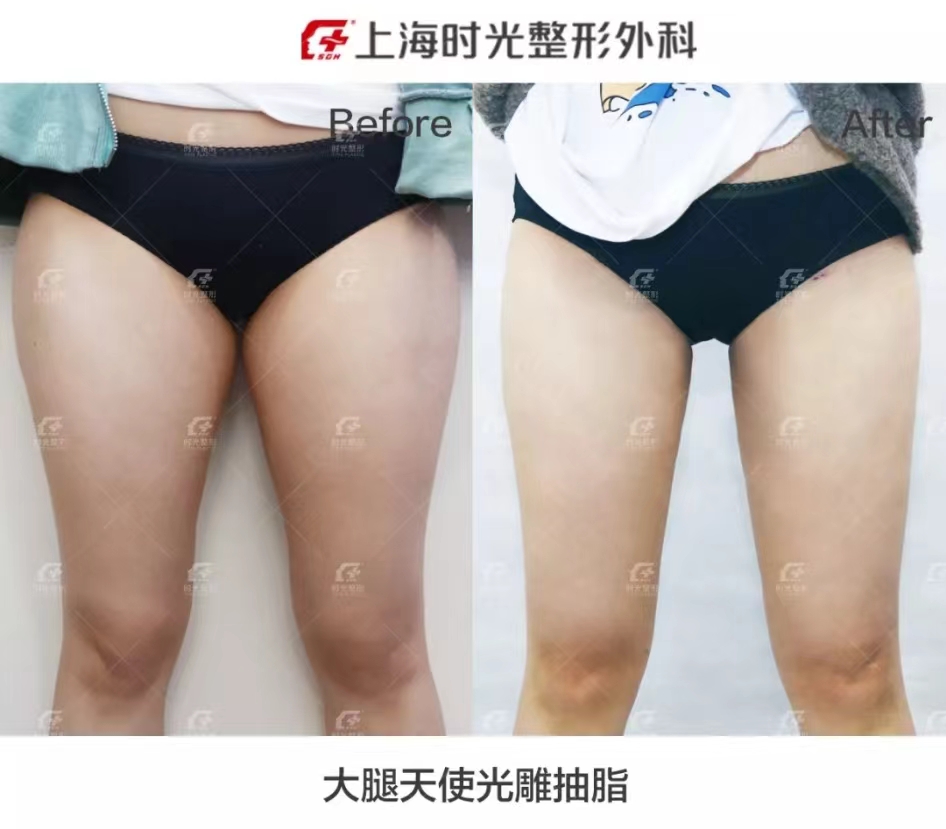 二、杭州彭濤醫(yī)生的FSE分層吸脂技術(shù)