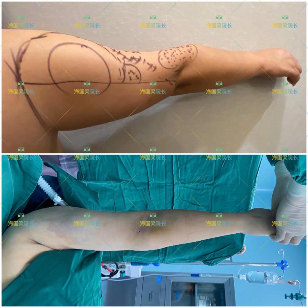 分層吸脂技術(shù)優(yōu)勢與成效展現(xiàn)