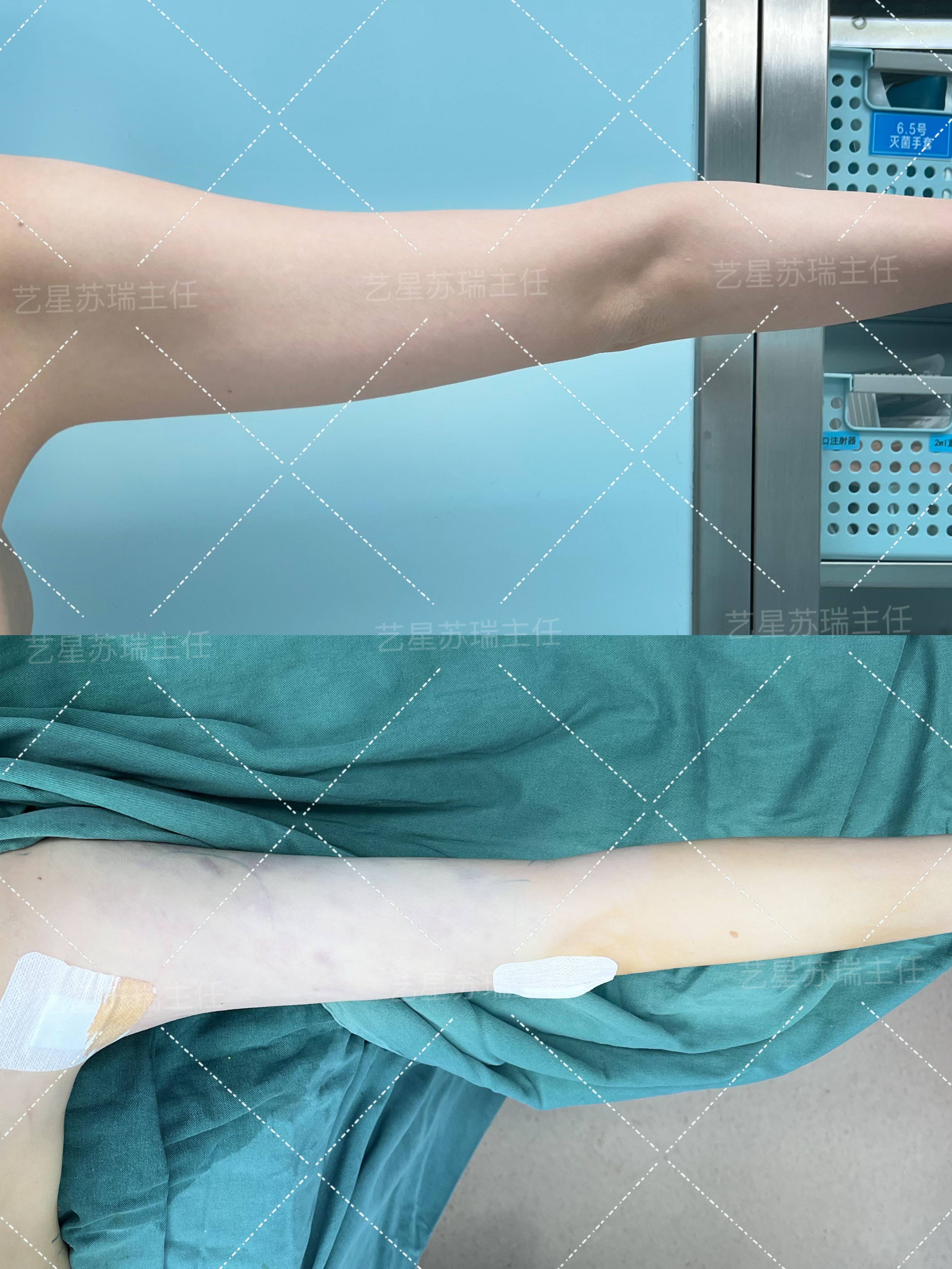 O型腿矯正技術(shù)亮點(diǎn)與成功實(shí)例