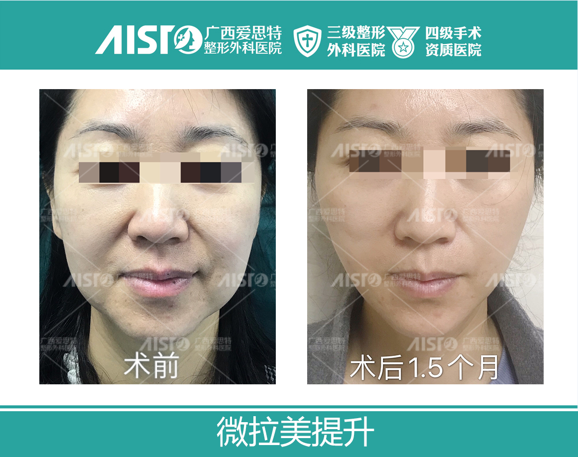 三、宋連成拉皮成功實(shí)例分享