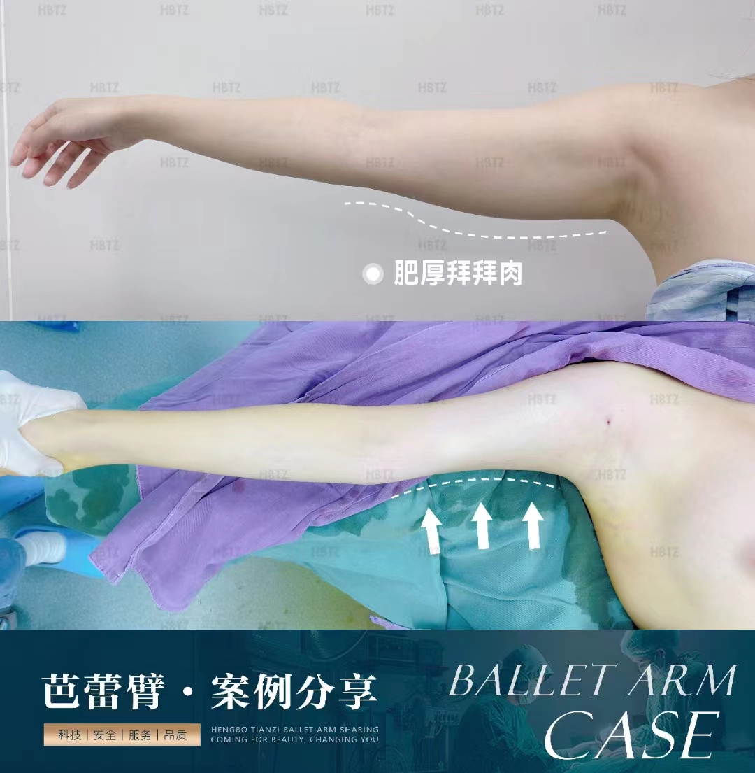 三、杭州彭濤醫(yī)生的吸脂風(fēng)格m.sorencai.cn