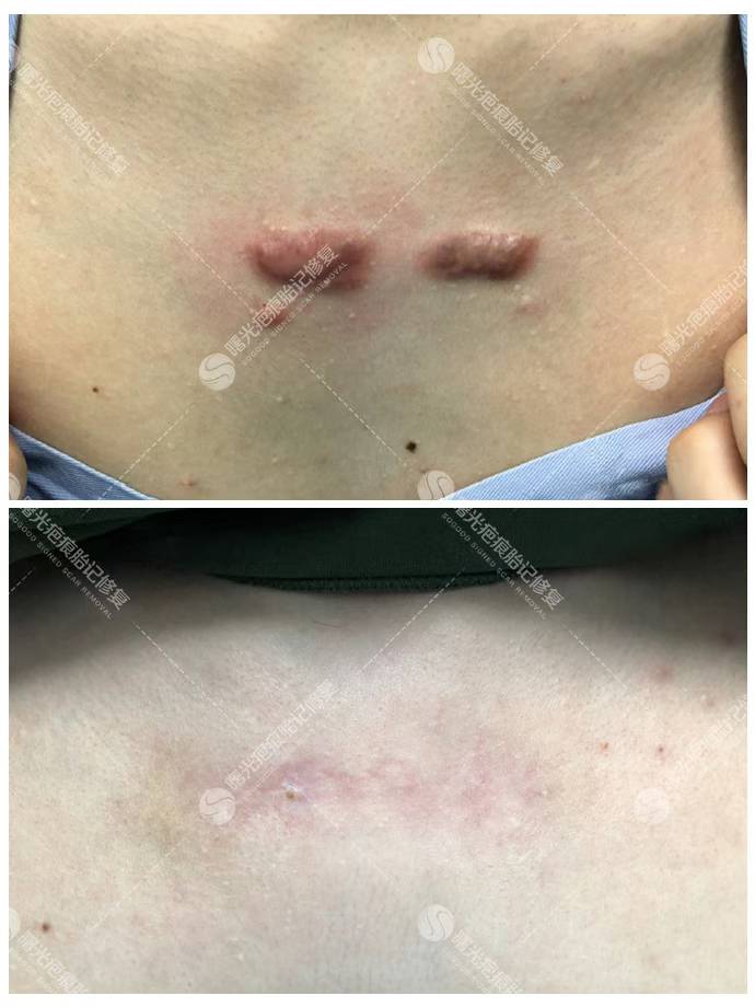 成都李繼華醫(yī)生假體墊下巴實(shí)例及成效