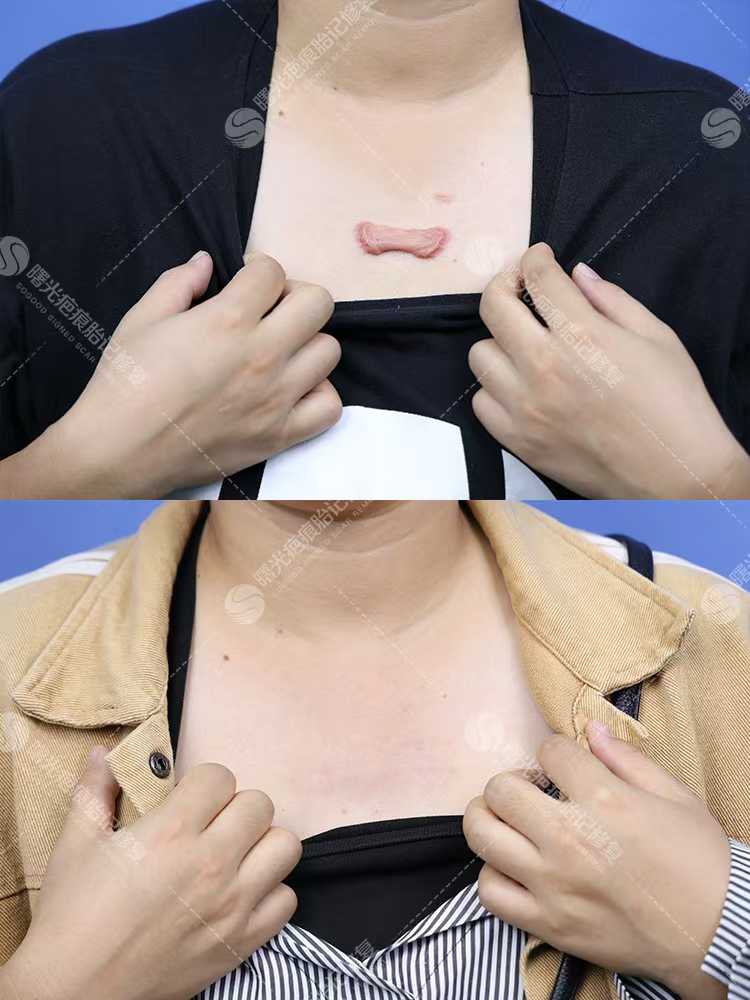 假體墊下巴手術(shù)過(guò)程及修復(fù)情況