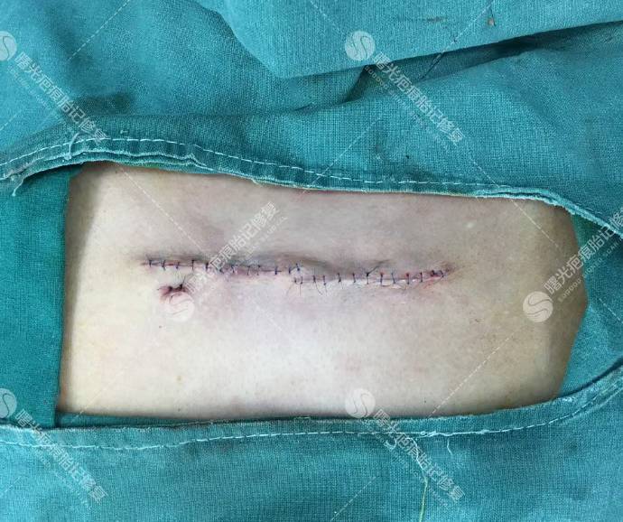 假體墊下巴的注意事項(xiàng)及風(fēng)險(xiǎn)