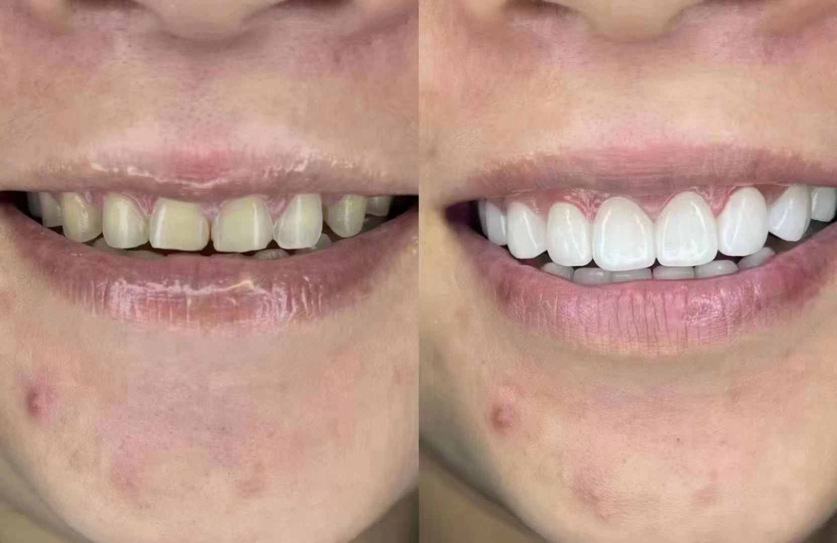 華 西口腔種植牙2026價格的實操指南