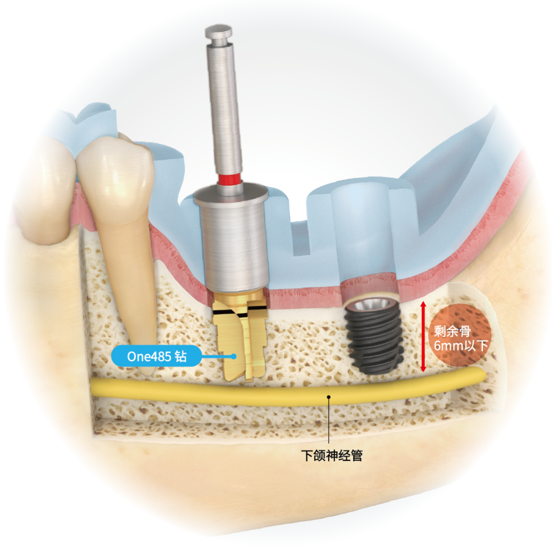 2026上海中喜慧麗口腔醫(yī)院收費(fèi)價格表：種植牙598元起+補(bǔ)牙299元+活動假牙1980元