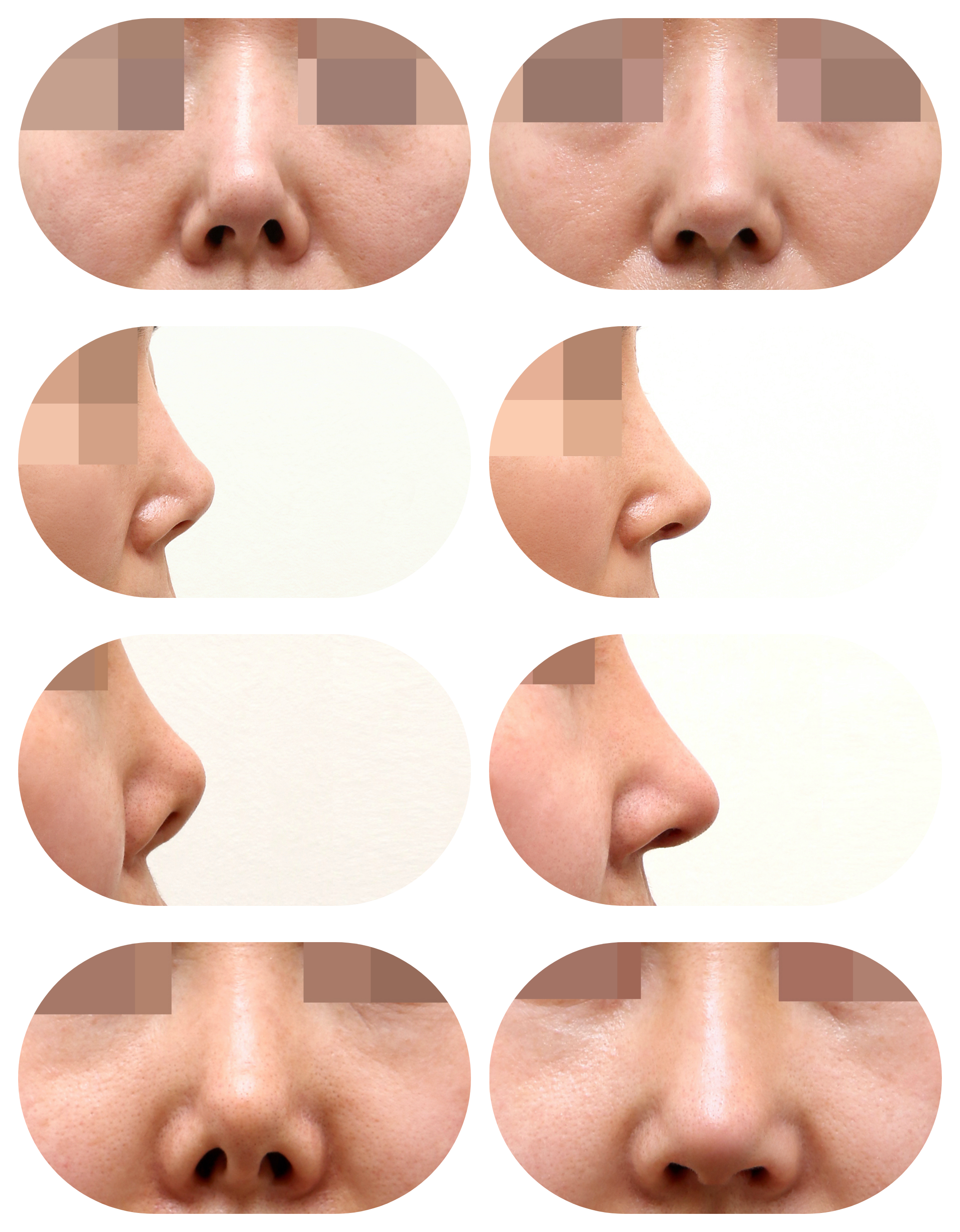 深圳張輝隆鼻避雷情況不實(shí)，正規(guī)資質(zhì)+真實(shí)案例，多年穩(wěn)定口碑，實(shí)力經(jīng)得起檢驗(yàn)