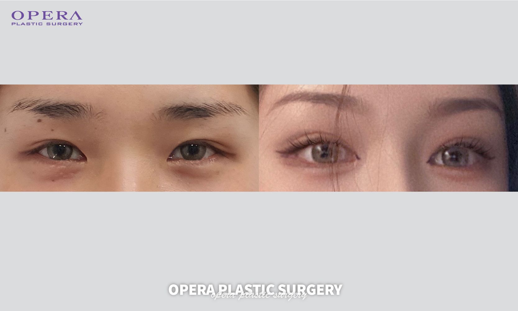 譚拯人中真的不留痕跡嗎?800+案例驗(yàn)證隱蔽切口+分層縫合技術(shù)，2026在深圳藝星坐診可約