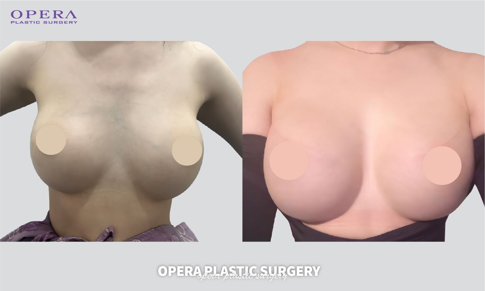 譚拯人中整形術(shù)后無痕護(hù)理指南