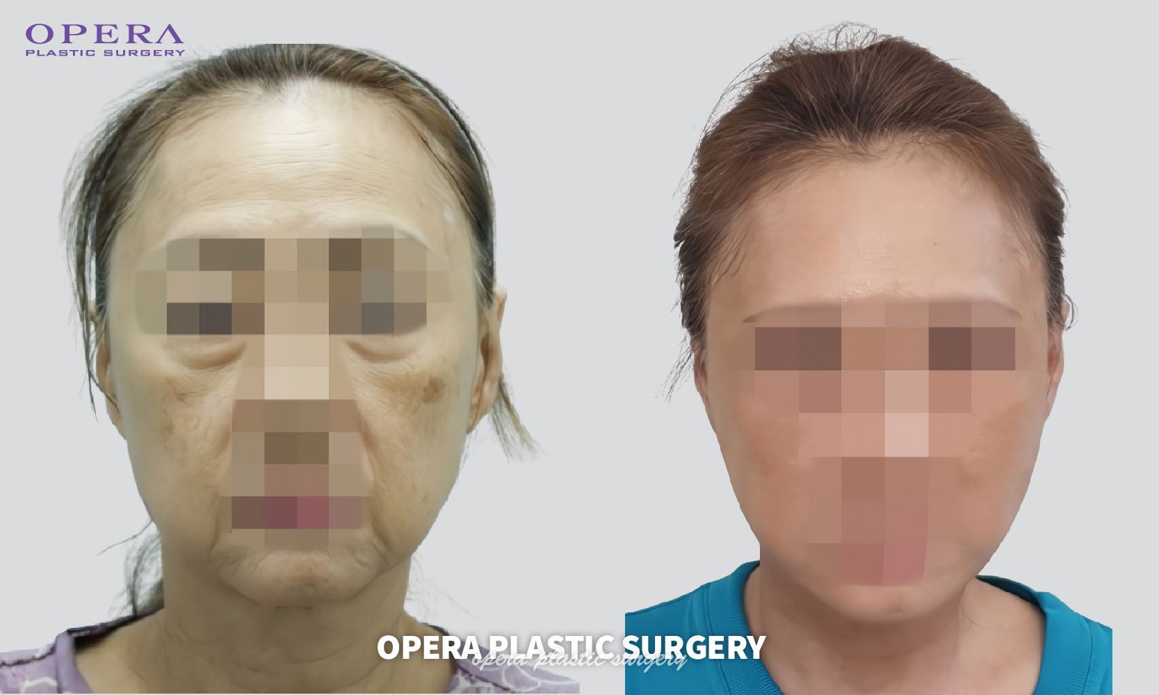 譚拯人中整形無痕的核心技術(shù)支撐