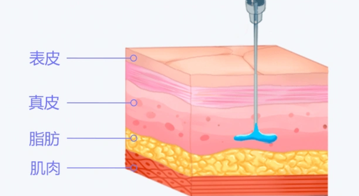 如何科學(xué)延長輕薄針維持時(shí)間？