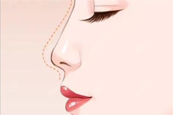 超全成都西區(qū)醫(yī)院整形鄧東偉預約掛號指南給你！附出診時間和鼻修復收費標準